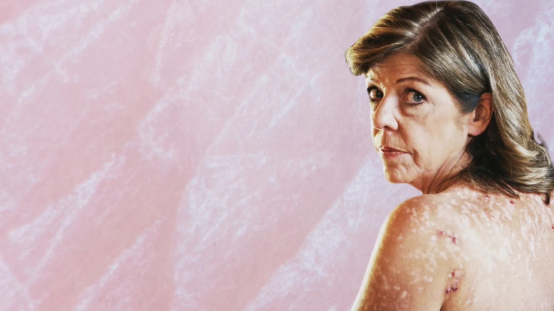Skin Deep: The Battle Over Morgellons
